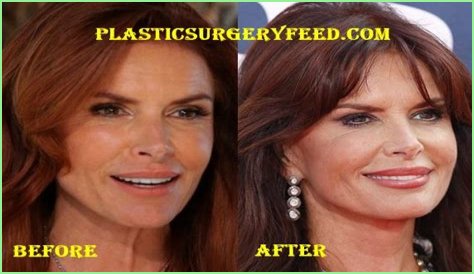 Roma Downey Plastic Surgery Before and After